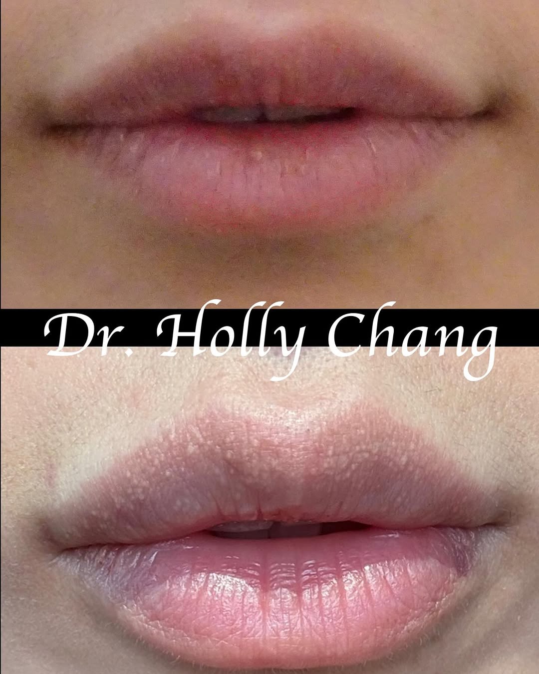 Instagram post by Dr. Holly Chang: A lesson in subtlety. This patient with a keen eye wanted 1. to show less teeth with jaws relaxed, 2. to have equal upper and lower lip heig…