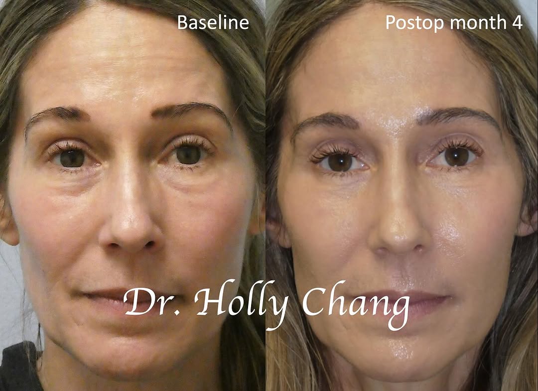 Instagram post by Dr. Holly Chang: After tear trough filler, PRP injections, and Tox, this woman developed festoons and looked worse. She came to me for help and I dissolved o…