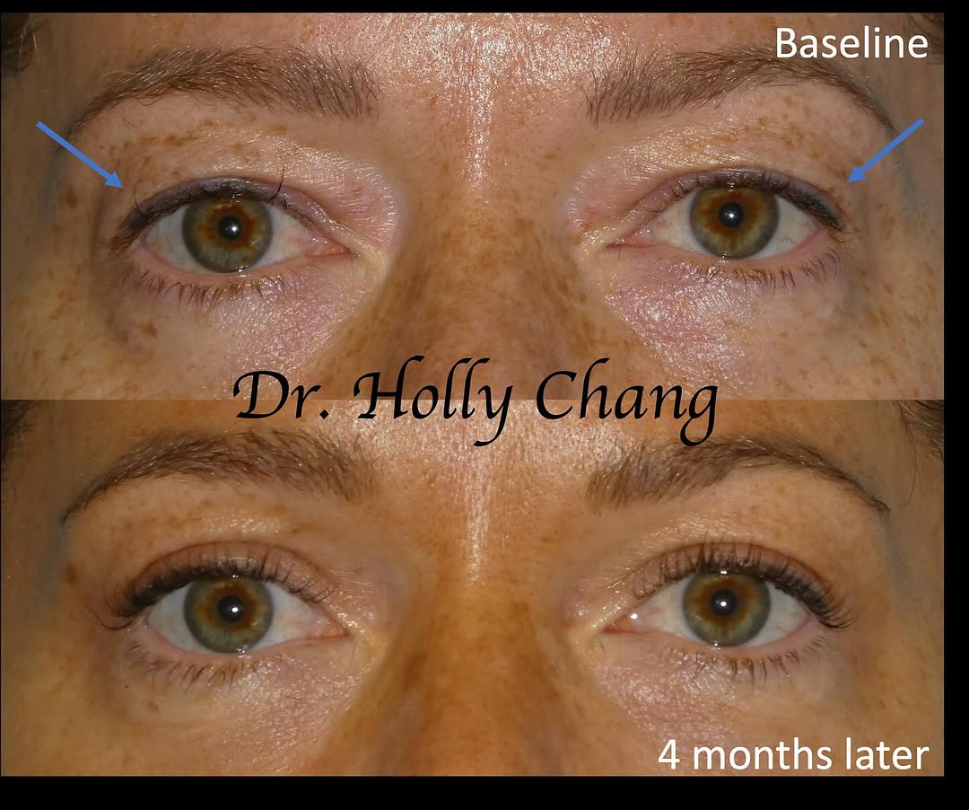 Instagram post by Dr. Holly Chang: A natural, beautiful upper blepharoplasty result. She tells me she’s getting unsolicited compliments on her eyes again! And, coincidence or …