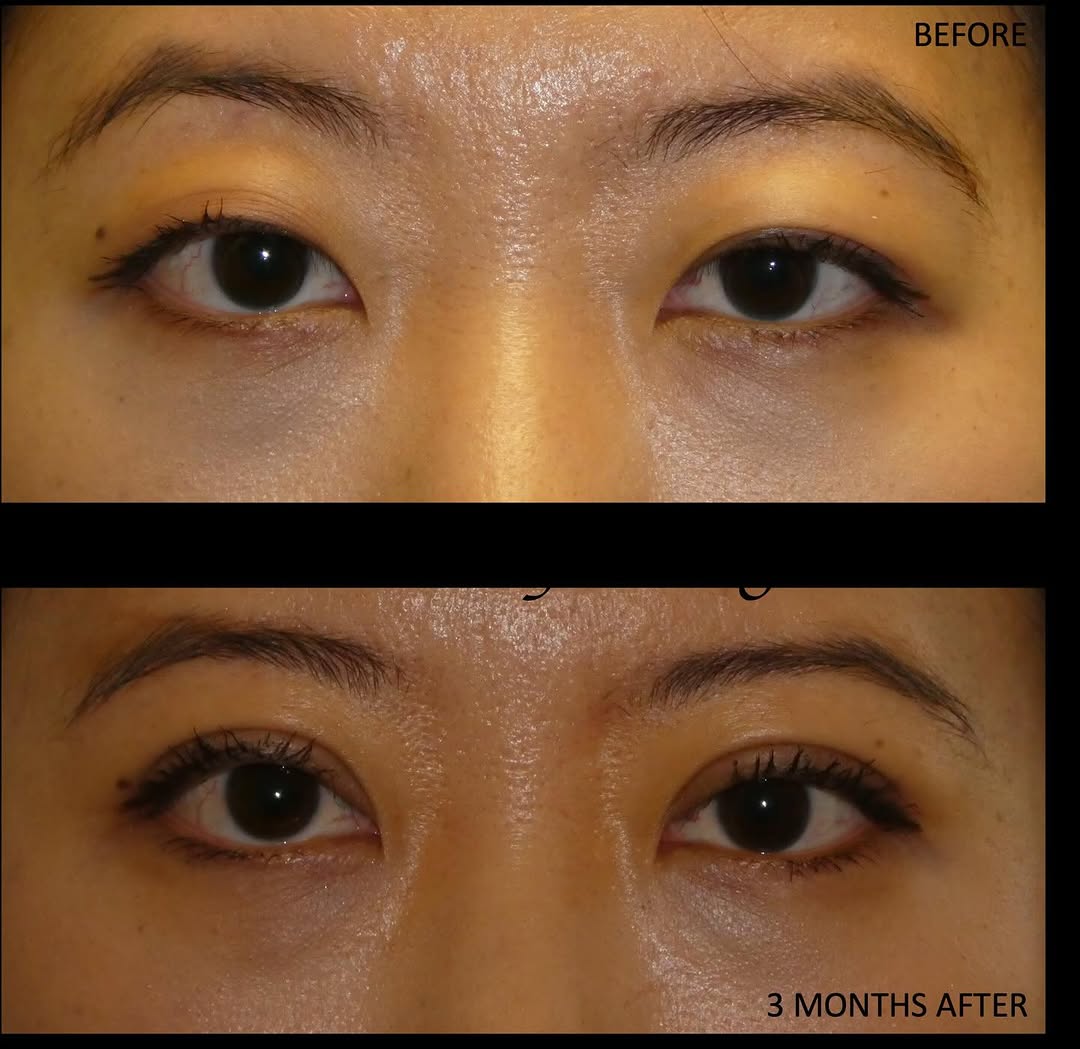 Instagram post by Dr. Holly Chang: Creating creases on an Asian eyelid is science + art. This lovely woman now has the eyelid structure she envisioned for herself, with enhanc…