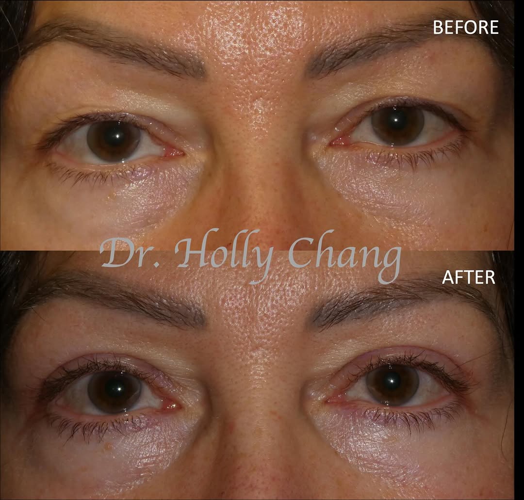 Instagram post by Dr. Holly Chang: After upper eyelid blepharoplasty & ptosis surgery, this beautiful woman’s eyes look simultaneously brighter & softer. Don’t you agree? #eye…