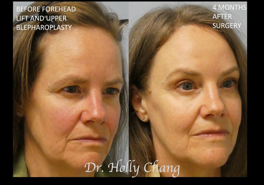 Instagram post by Dr. Holly Chang: A beautiful person, inside and out, whose face now matches her naturally warm and cheerful personality! She is 4+ months out from trichophyt…
