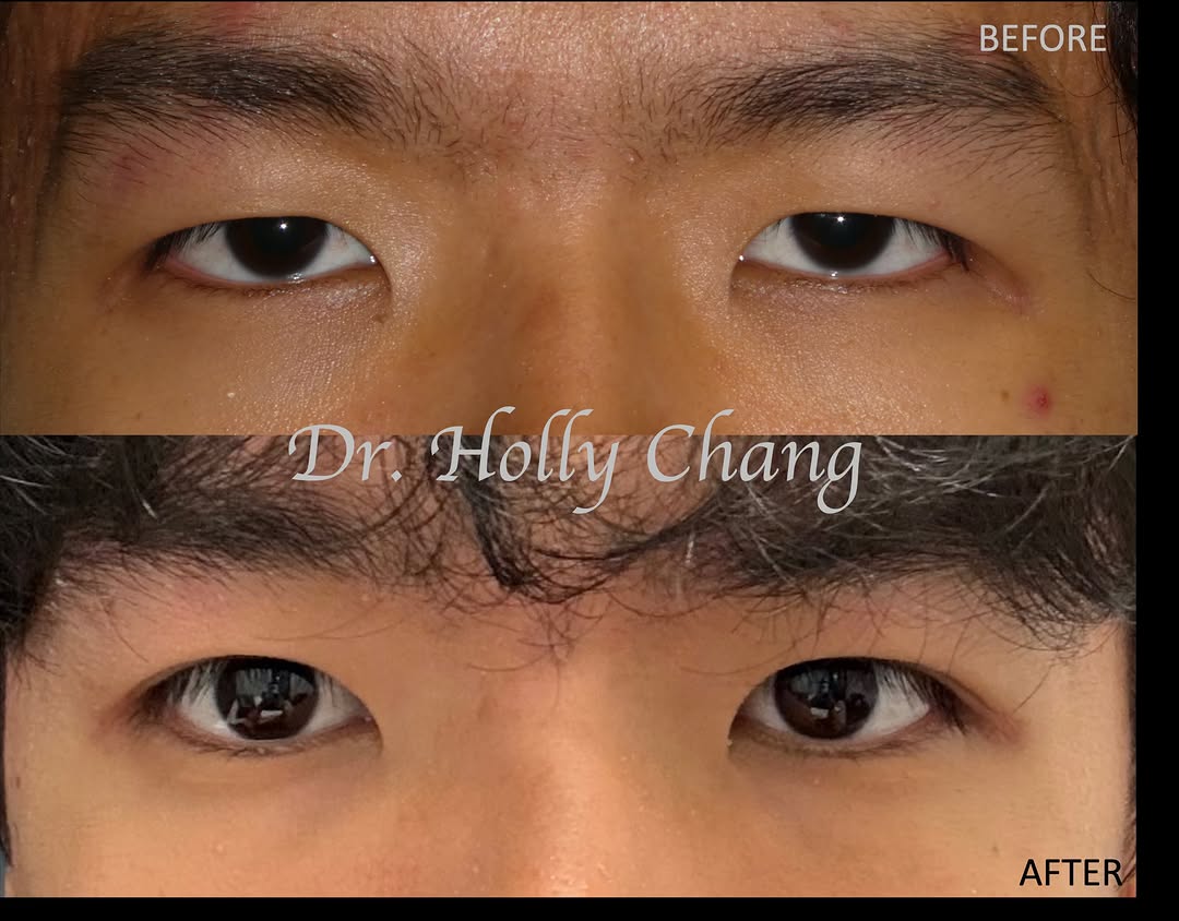 Instagram post by Dr. Holly Chang: Razor thin margin of error when performing double eyelid surgery on young Asian men. This 22 year old traveled from out of state for me to p…