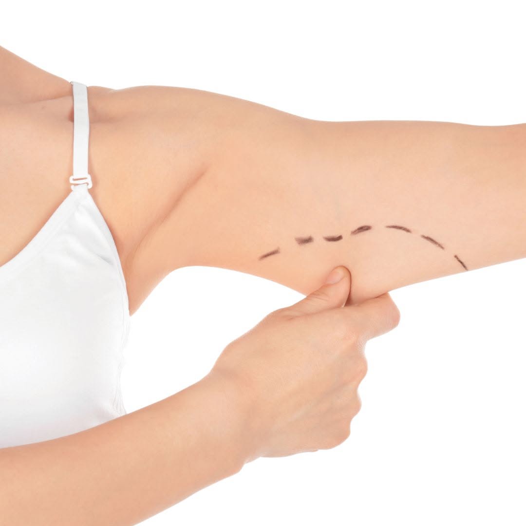 Instagram post by Dr. Homayoun Sasson: Say goodbye to unwanted arm fat! If you feel embarrassed about wearing sleeveless or short-sleeved tops because of the appearance of your ar…