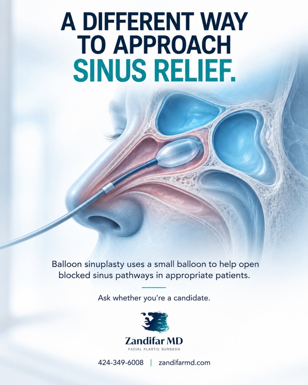 Instagram post by Dr. Hootan Zandifar: Still dealing with pressure, congestion, or recurring sinus symptoms? Balloon sinuplasty is a minimally invasive option that uses a small ba…