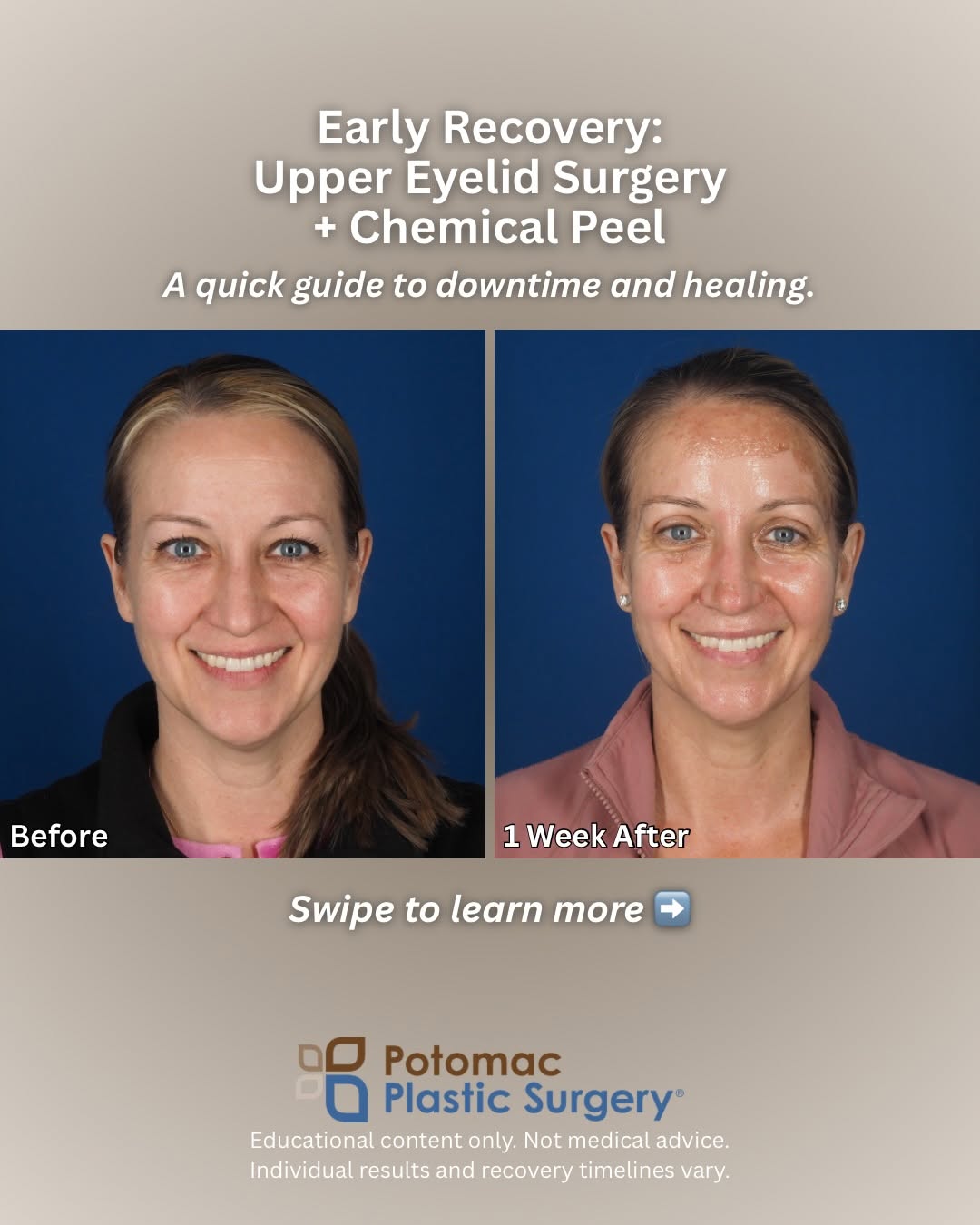 Instagram post by Dr. Houtan Chaboki: What to Expect: Upper Eyelid Solutions Quick fixes with in-office can only do so much. When skin is heavy enough to block your vision, surgi…