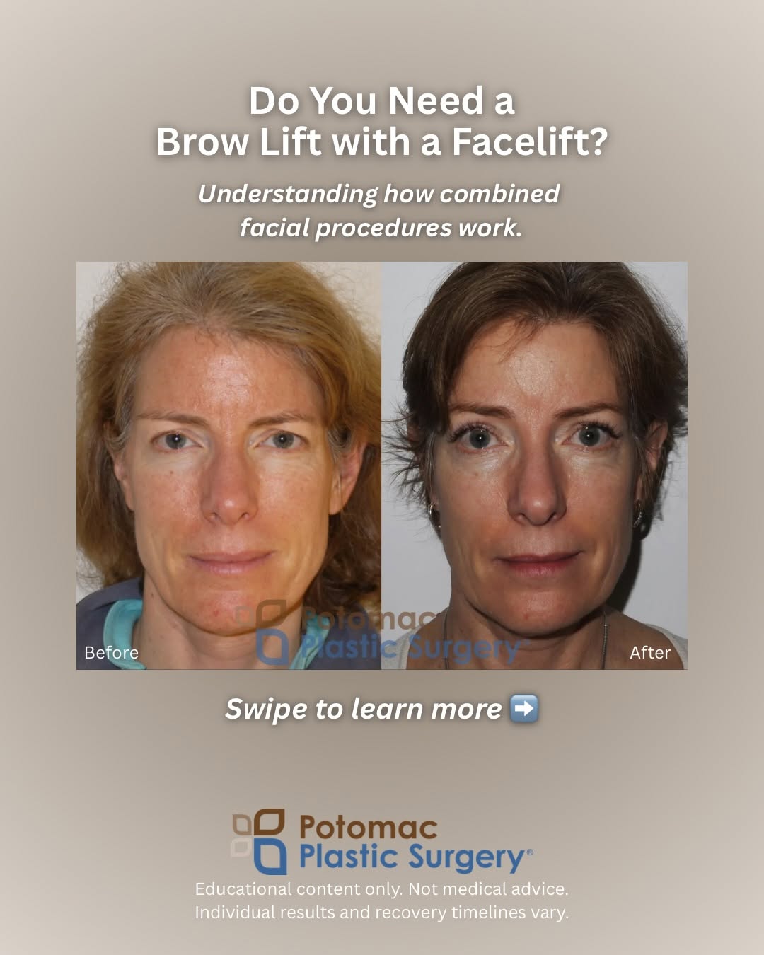 Instagram post by Dr. Houtan Chaboki: Do you need a brow lift with your facelift or are they two totally separate decisions? 👀 Swipe through to understand how these procedures w…