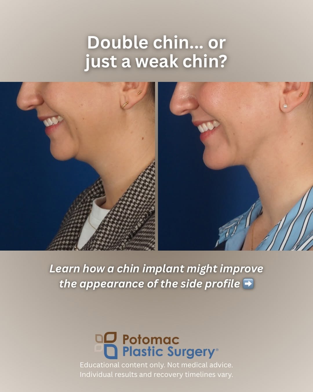 Instagram post by Dr. Houtan Chaboki: Double chin isn’t always fat. 🤔 Sometimes it’s a weak chin pulling the skin back and not extra fat under the jaw. A chin implant can bring …