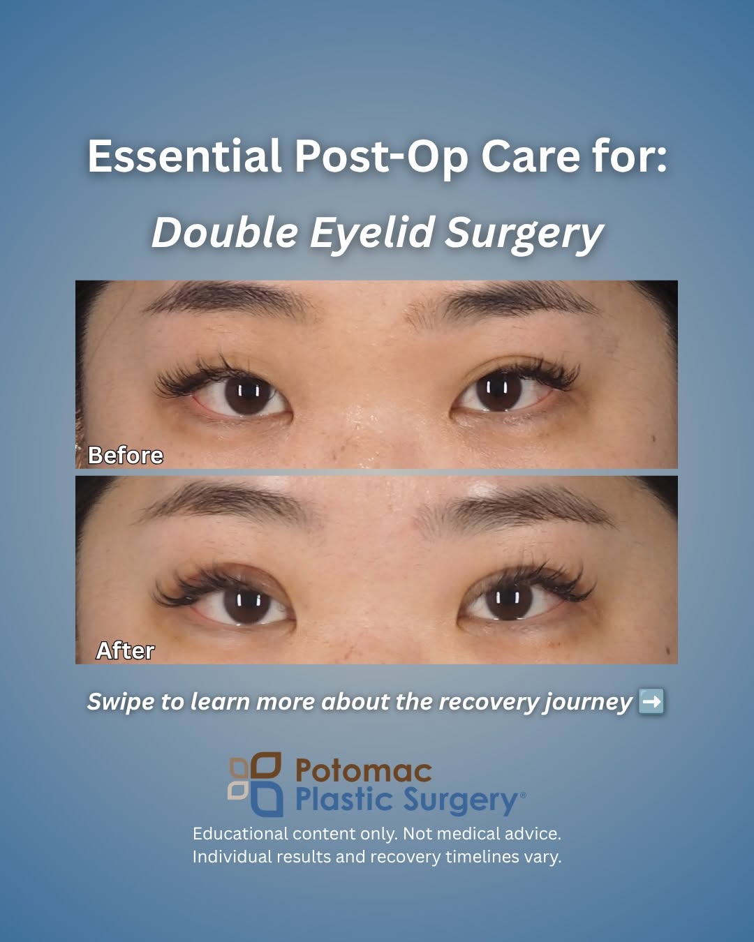 Instagram post by Dr. Houtan Chaboki: Proper post-op care is just as important as the procedure itself when it comes to your double eyelid results. 👁️✨ During initial healing, k…