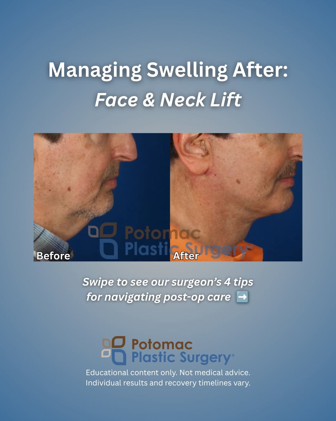 Instagram post by Dr. Houtan Chaboki: Swelling is a normal, expected part of the natural healing process following facial plastic surgery. 🩹✨ While swelling peaks early and grad…