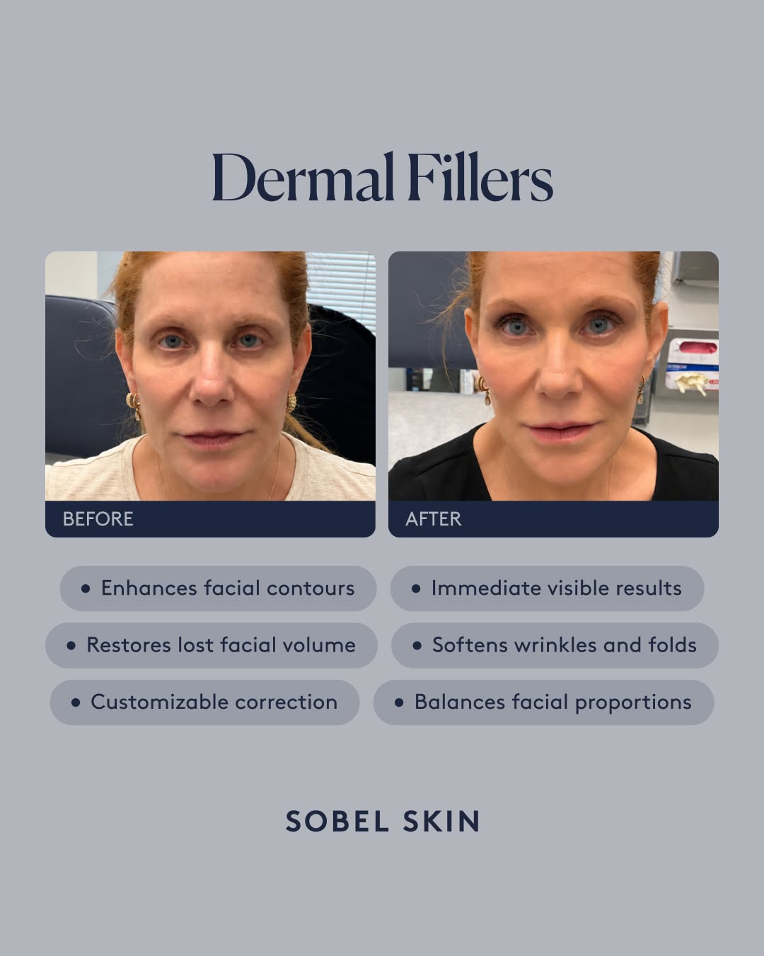 Instagram post by Dr. Howard D. Sobel: A small change can make such a noticeable difference when it’s done with balance in mind 🙌🏻 Dermal fillers helped restore volume, refine t…