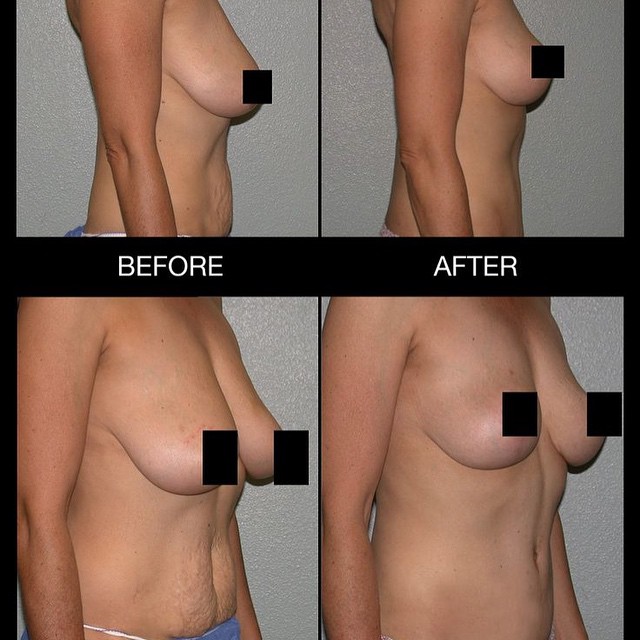 Instagram post by Dr. Howard Gross: "This patient wanted to get rid of her loose skin on her abdomen and to lift her breasts. The “after” photo was taken 6 months post procedur…