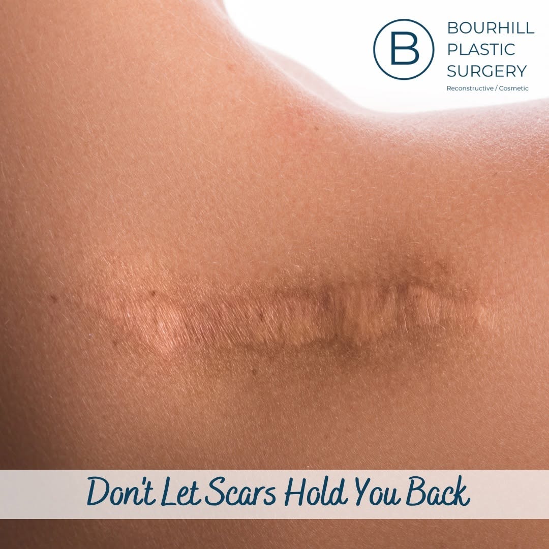 Instagram post by Dr. Ian L. Bourhill: Scars can be a constant reminder of past surgeries or accidents, but they don't have to be permanent. At Bourhill Plastic Surgery, Dr. Bourh…