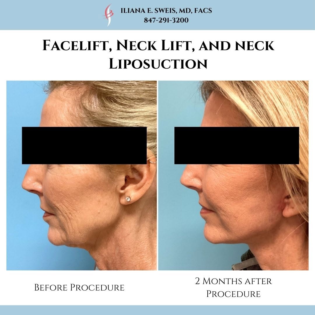 Instagram post by Dr. Iliana Sweis: Swipe to see more of this facelift transformation! This lovely patient underwent a facelift, neck lift, and neck liposuction procedure perfo…