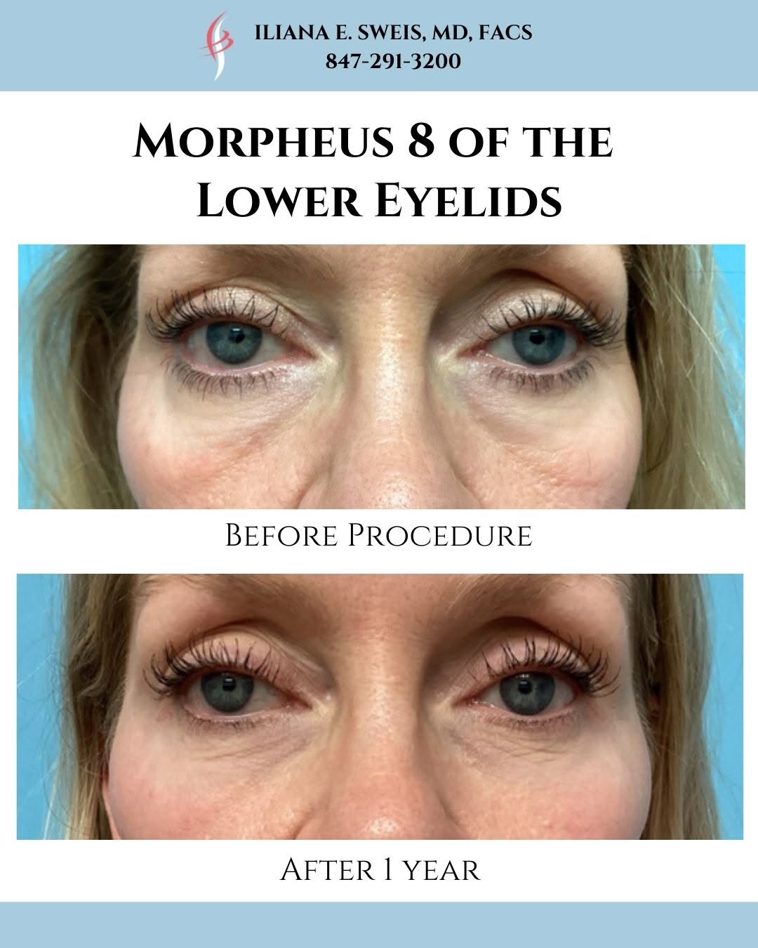 Instagram post by Dr. Iliana Sweis: Look at the results of this lovely patient who underwent Morpheus 8 to treat the puffiness along her lower eyelids. This patient presented c…