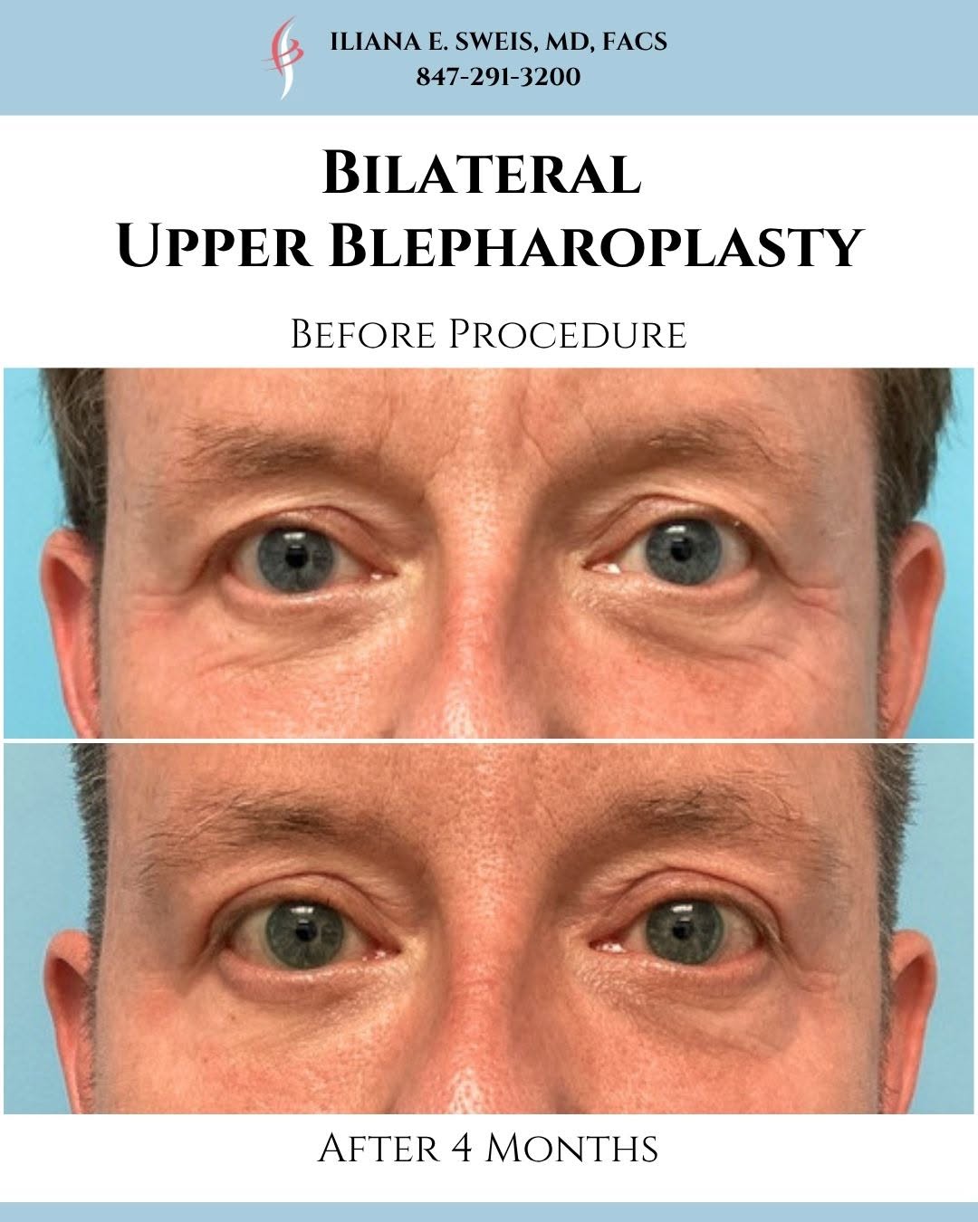 Instagram post by Dr. Iliana Sweis: As we age, our eyes experience changes that may make us look tired. This lovely patient was a great candidate for an upper blepharoplasty, a…