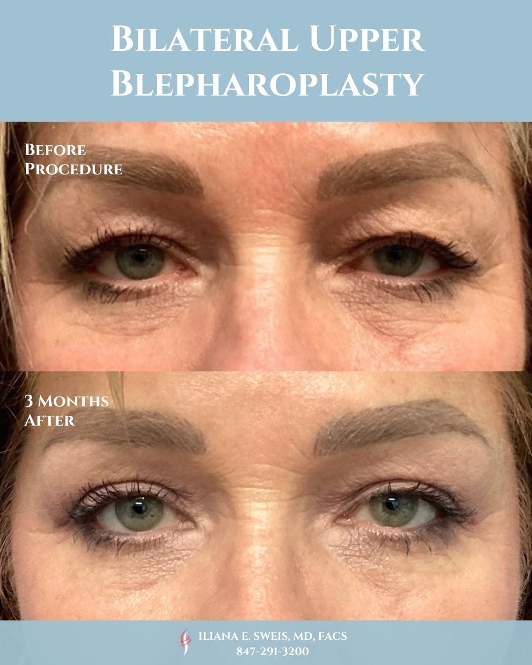 Instagram post by Dr. Iliana Sweis: Patients who think they look tired or that their eyes look heavy may be great candidates for an upper blepharoplasty. These are the results …