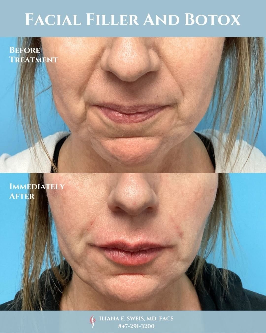 Instagram post by Dr. Iliana Sweis: Look at these beautiful results that can be achieved by using fillers and botox only! Our lovely patient presented with concerns regarding h…