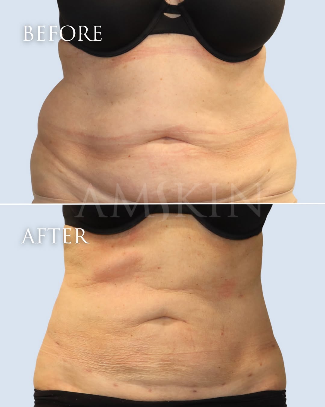 Instagram post by Dr. Ilya Reyter: Do you have stubborn fat that won’t budge with diet and exercise? Liposuction can help target those areas and deliver noticeable, fast resul…