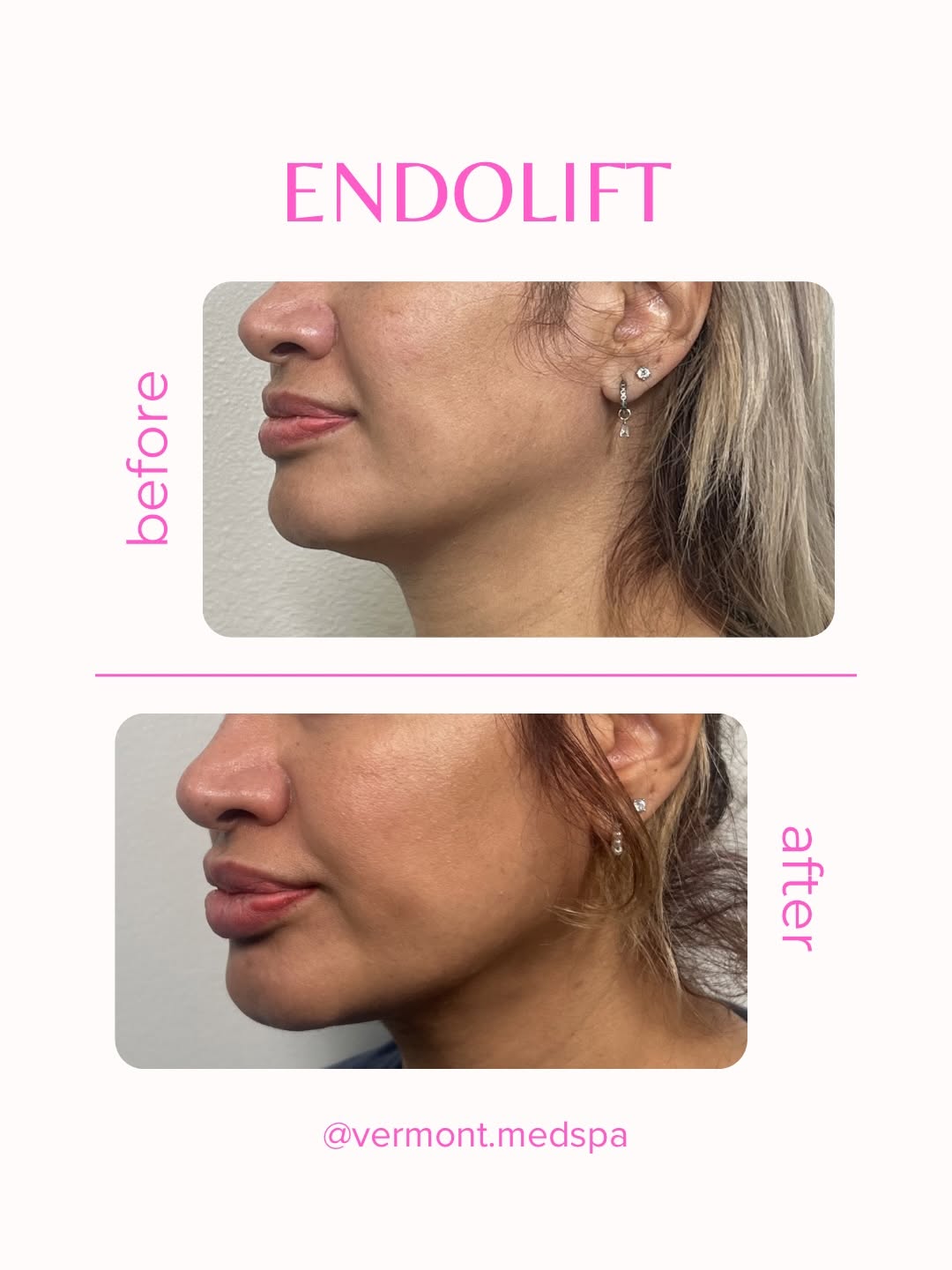 Instagram post by Dr. Imad Aziz El-Asmar: ✨ It’s not a dream—it’s Endolift. Tag someone who needs to see this! 👀 #jawlinelift #facecontouring