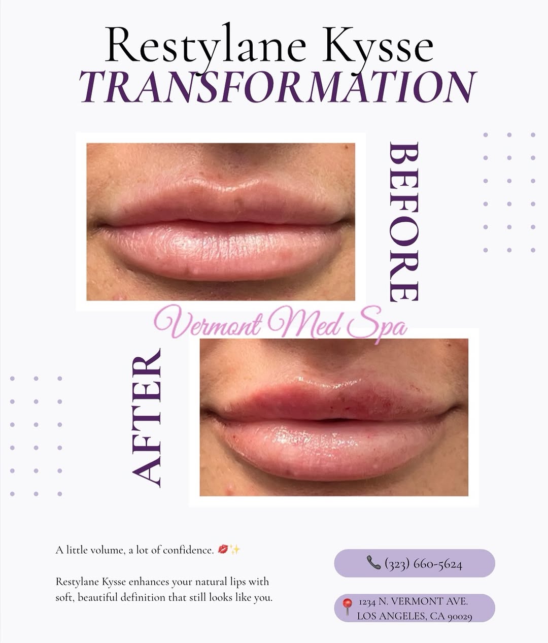 Instagram post by Dr. Imad Aziz El-Asmar: Soft. Hydrated. Perfectly balanced. ✨ That’s the magic of Restylane Kysse. Ready for your own lip transformation? Send us a DM to book. 💌 #…