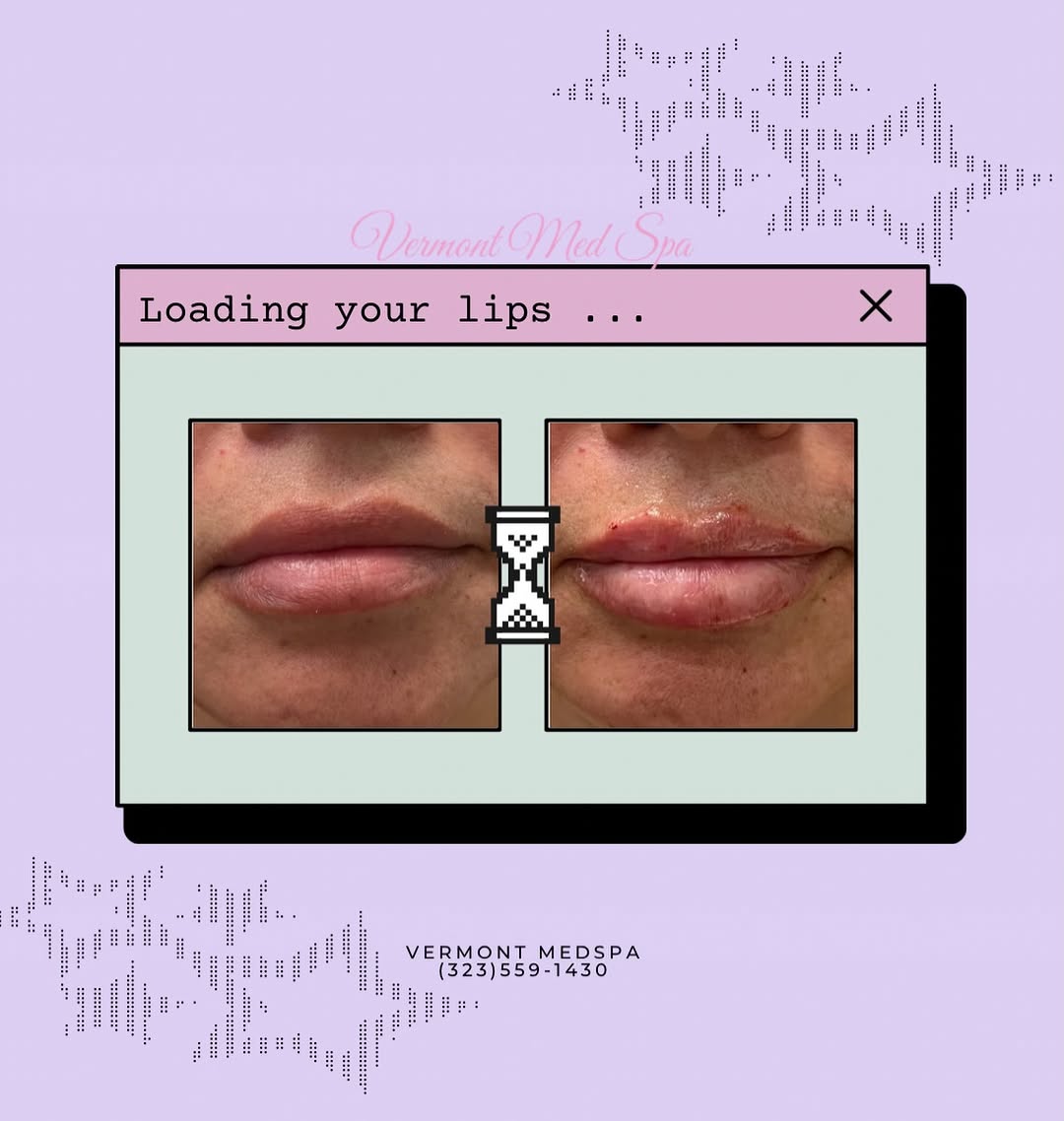 Instagram post by Dr. Imad Aziz El-Asmar: A little volume. A little definition. A whole lot of confidence 💋✨ Our approach to lip filler is all about enhancing your natural features …