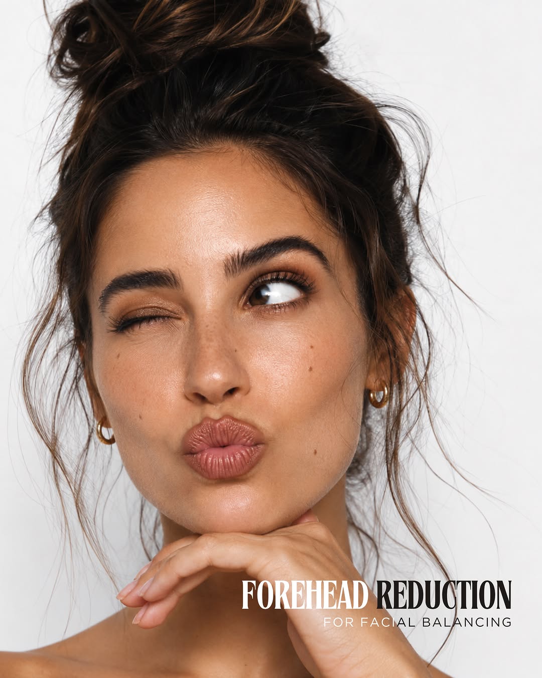 Instagram post by Dr. Inessa Fishman: A forehead that feels too tall is often less about the forehead itself and more about overall facial proportions. This lovely patient came t…