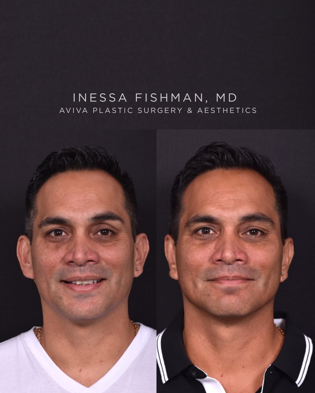Instagram post by Dr. Inessa Fishman: Revision otoplasty is often more challenging than performing ear surgery for the first time, but it can also be incredibly rewarding. Unlike…