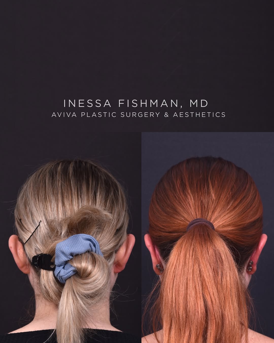 Instagram post by Dr. Inessa Fishman: This young woman and confident business owner had always been bothered by ears that felt a bit too prominent and slightly asymmetric. While …