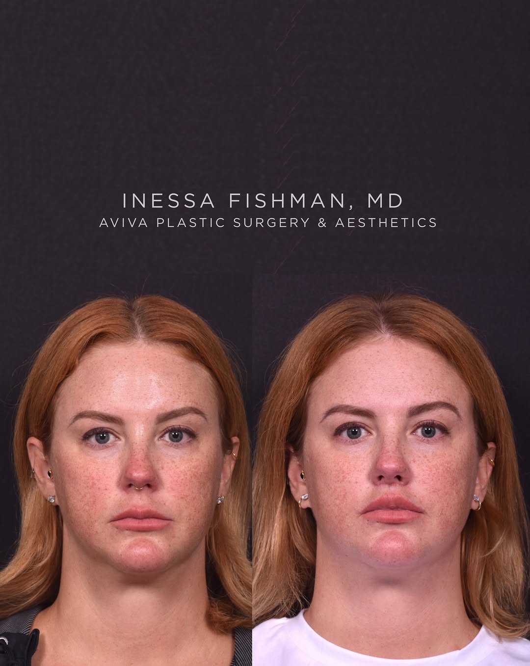 Instagram post by Dr. Inessa Fishman: Lip lift: early healing 🤍 This beautiful 39-year-old patient is shown 6 weeks after a subnasal upper lip lift + corner lip lift. At this ea…