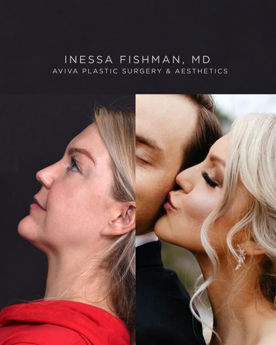 Instagram post by Dr. Inessa Fishman: Not every neck needs the big guns. A deep plane, structural neck lift can be an incredibly powerful operation, but excellent facial plastic …