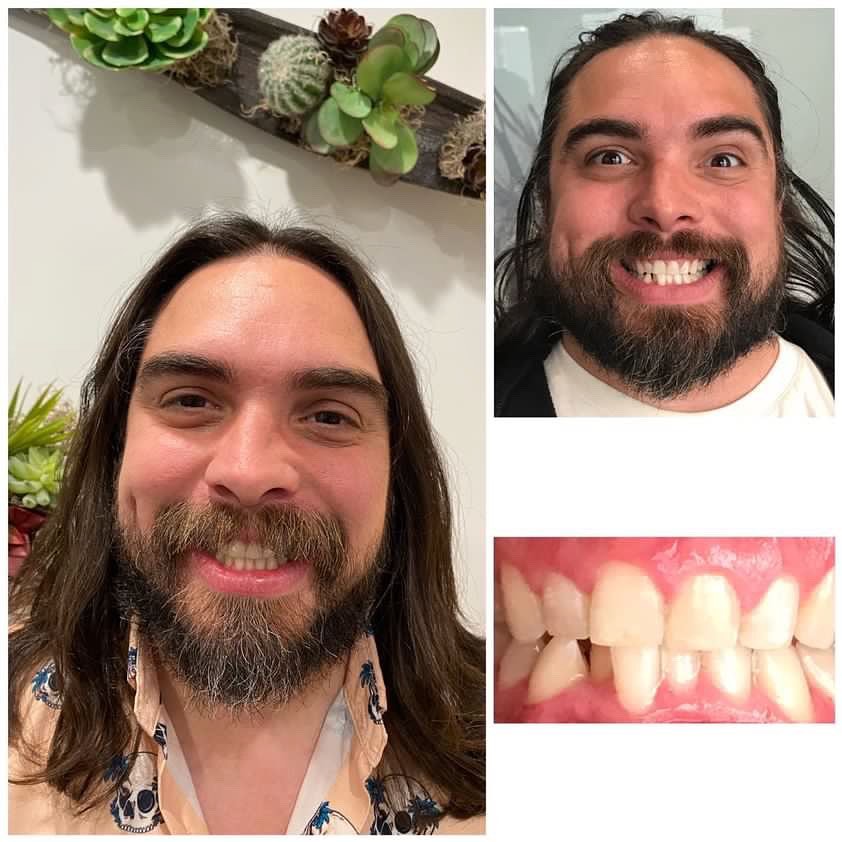 Instagram post by Dr. Inna Rostker: We love seeing real results! Happy 16 week Invisalign anniversary @lifesatrail 😁🥳👏#invisalignjourney #happypatient