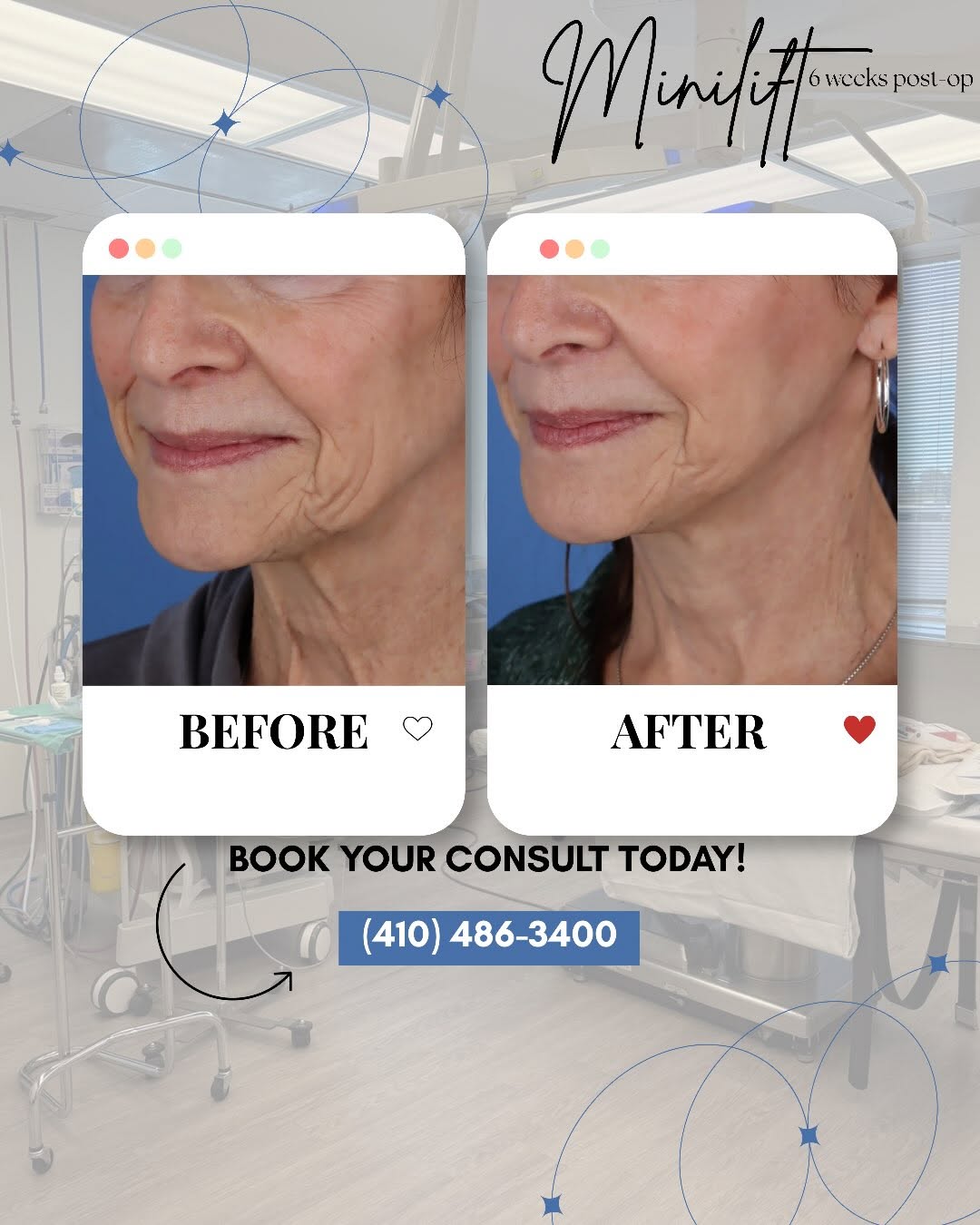 Instagram post by Dr. Ira D. Papel: Can you believe these results are only 6 weeks post-op?! 🤩 When we asked her how the healing process had been, she said, “It was so extreme…