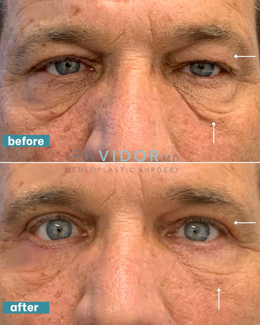 Instagram post by Dr. Ira Vidor: Subtle refinement with a noticeable impact. This patient underwent upper and lower blepharoplasty to improve excess eyelid tissue and under-…