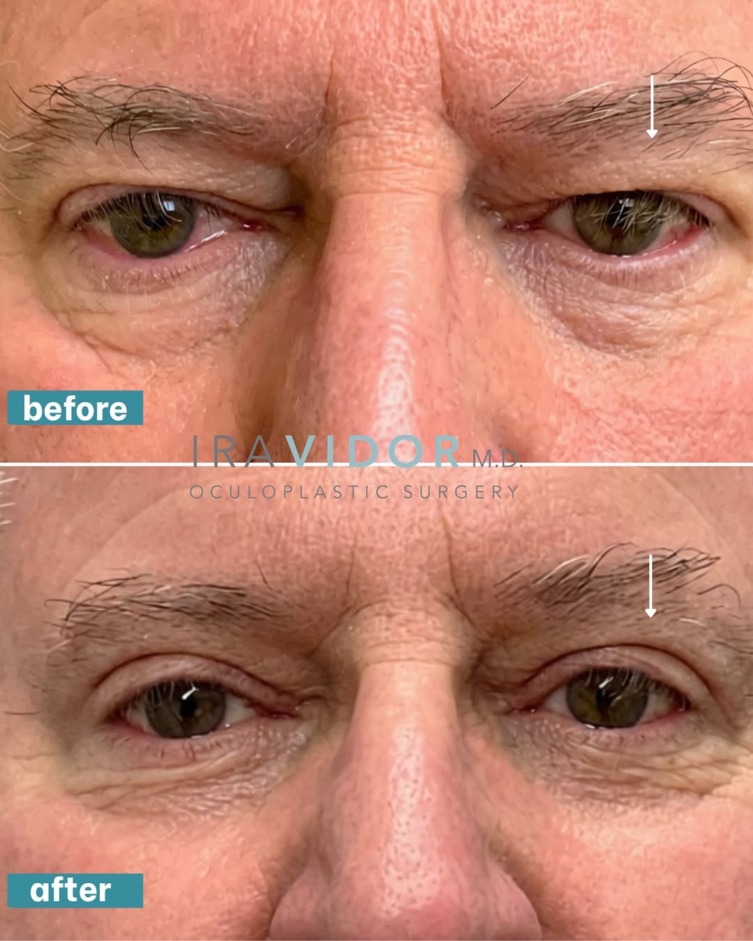 Instagram post by Dr. Ira Vidor: Less heaviness. More definition. A blepharoplasty with a natural looking result.