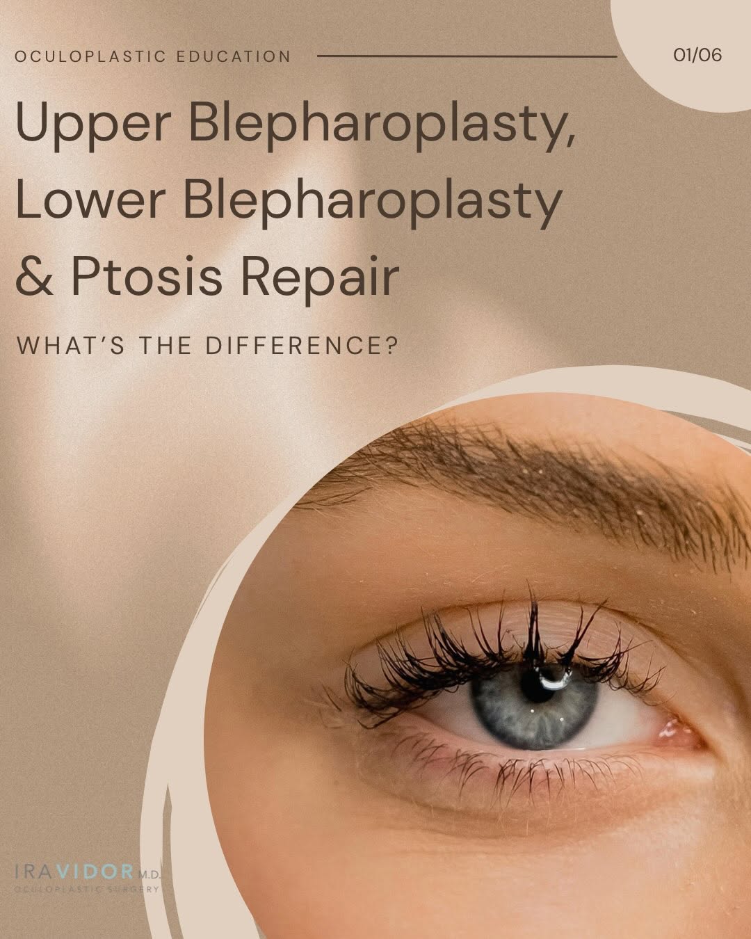 Instagram post by Dr. Ira Vidor: Blepharoplasty or ptosis repair— what’s the difference? While these procedures all involve the eyelids, they’re designed to address differen…