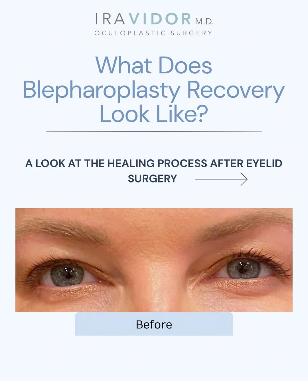 Instagram post by Dr. Ira Vidor: Blepharoplasty recovery is a process, not an overnight transformation. 🤍