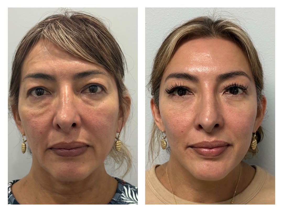 Instagram post by Dr. Irina Minina: She came in a few months ago and just wanted to look like herself again . She’d had fillers done somewhere else and it didn’t go well — the …