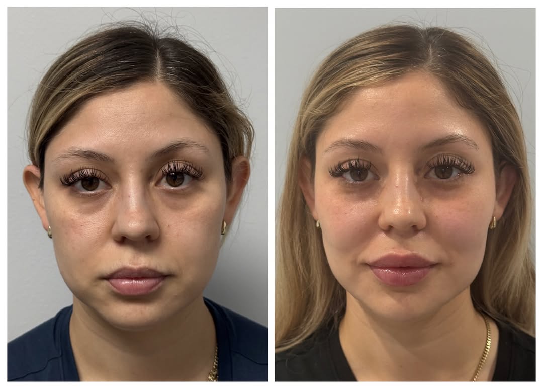 Instagram post by Dr. Irina Minina: Filler as punctuation, not the whole sentence. 🤍 Because your face already has something to say — it just needed the right pause in the rig…