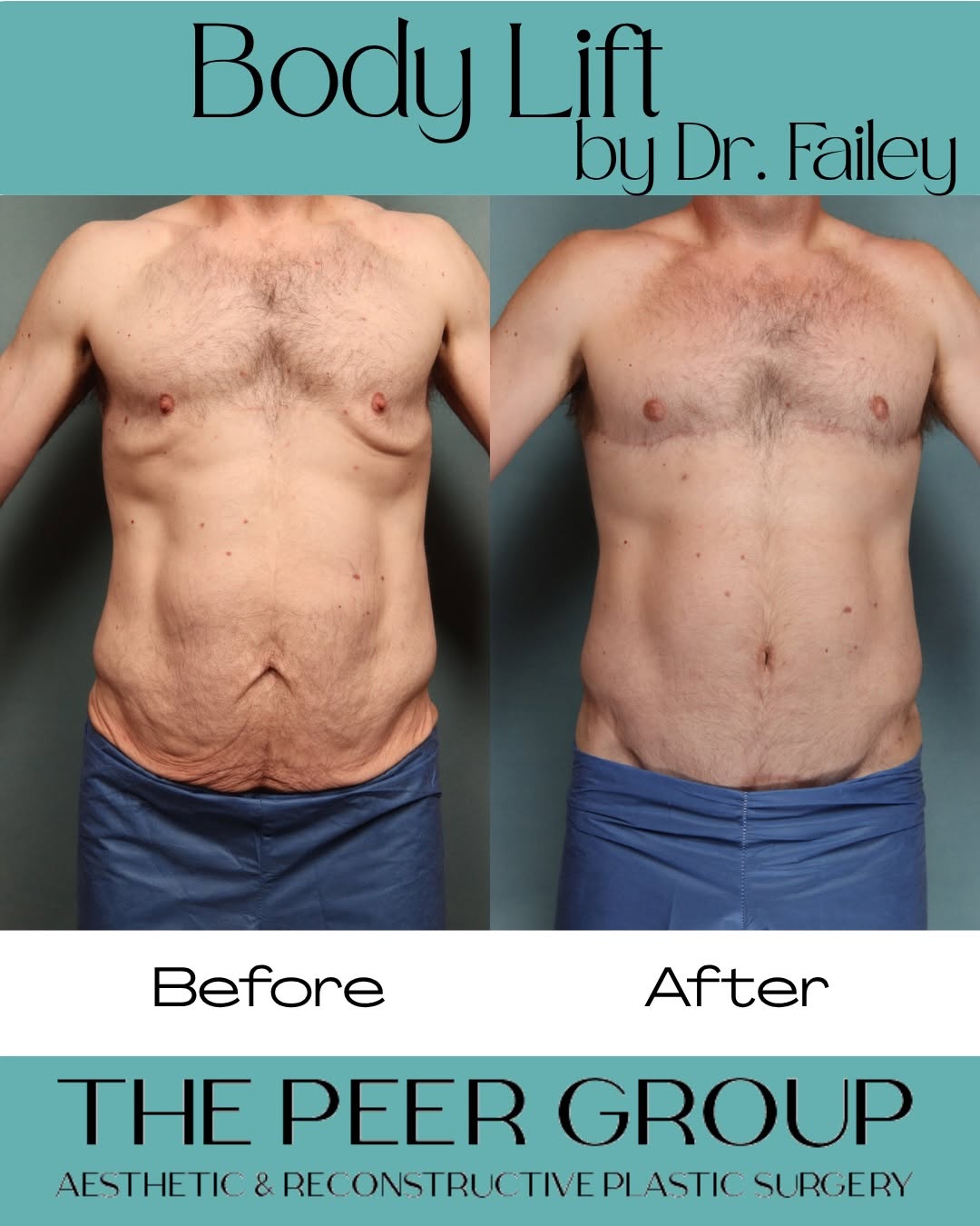 Instagram post by Dr. Isaac Starker: 💪 Hard Work. Dedication. Transformation. This amazing before & after shows a male patient following significant weight loss and body lift s…