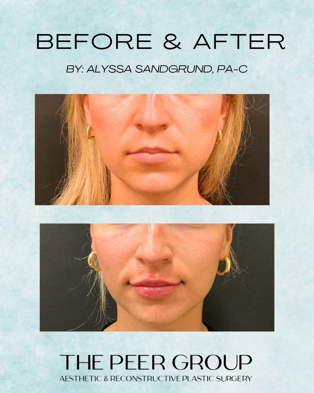 Instagram post by Dr. Isaac Starker: 💫Before and after💫 Masseter Botox + lip filler can do more than treat each area individually — it can help create balance and harmony thro…