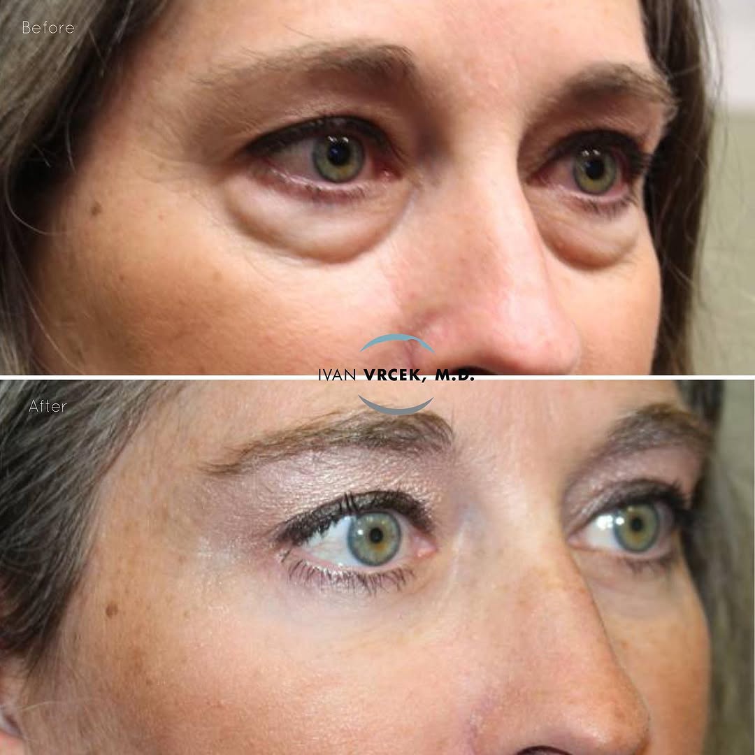 Instagram post by Dr. Ivan Vrcek: Time travel or surgery? 😉 This beautiful patient is loving her results 3 months after Lower Blepharoplasty with fat repositioning (using th…