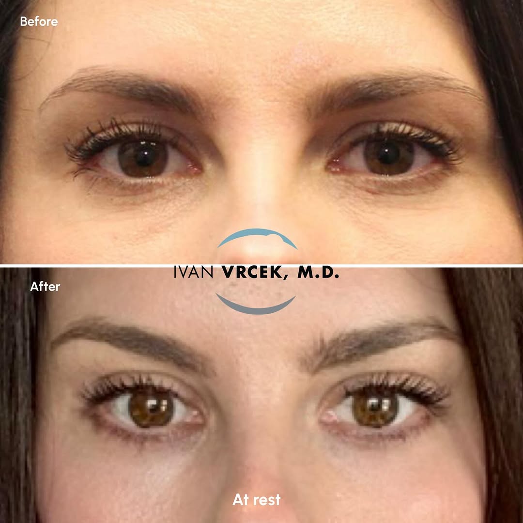 Instagram post by Dr. Ivan Vrcek: Looking beautiful just 6 weeks after Upper and Lower Blepharoplasty with fat repositioning, an endoscopic brow lift, a skin pinch, and a che…
