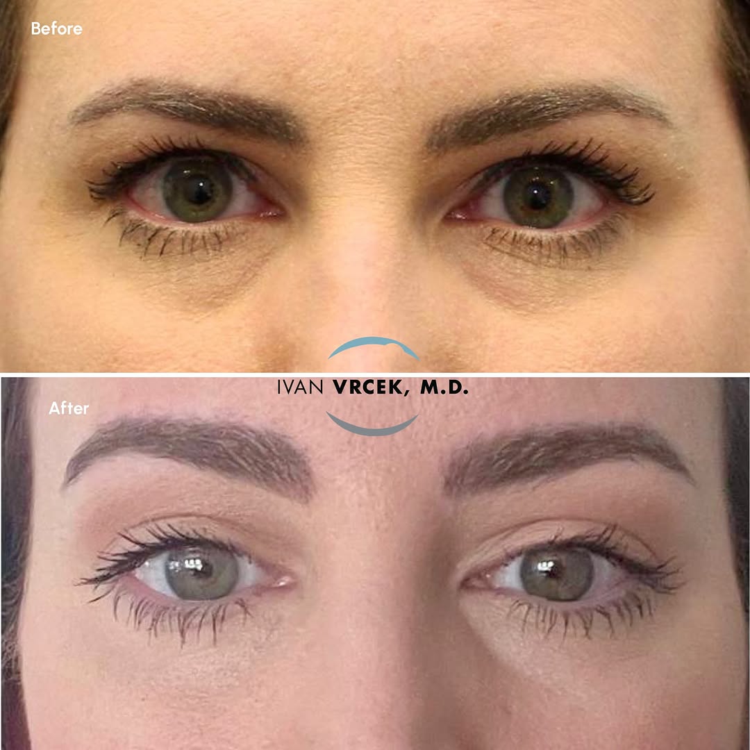 Instagram post by Dr. Ivan Vrcek: Looking beautiful just 6 weeks after upper blepharoplasty with an endoscopic brow lift! *Patient provided images #plasticsurgerybeforeandaft…