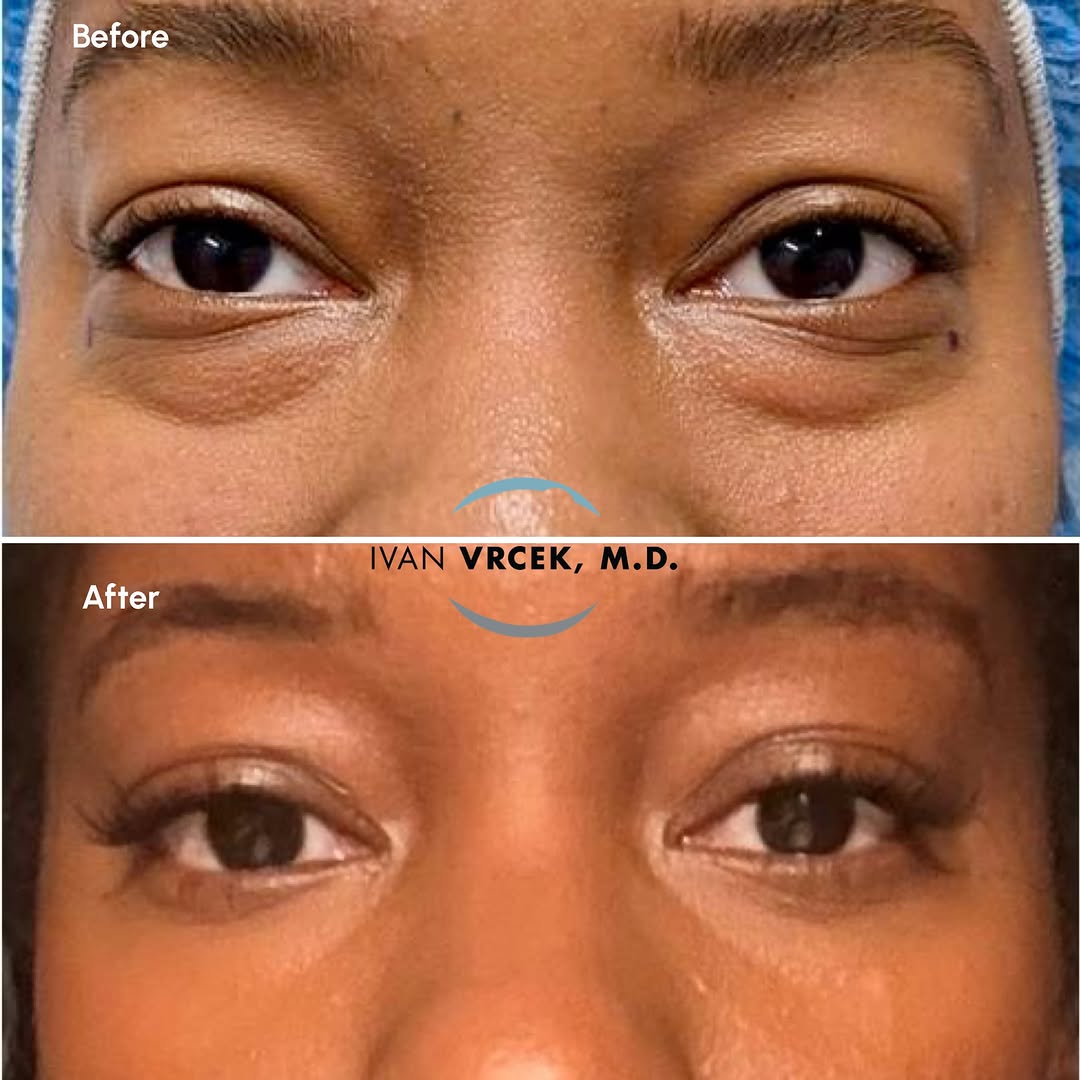 Instagram post by Dr. Ivan Vrcek: What a difference a lower blepharoplasty can make 😉 Before and 5 months after a customized lower blepharoplasty with fat repositioning *Pat…