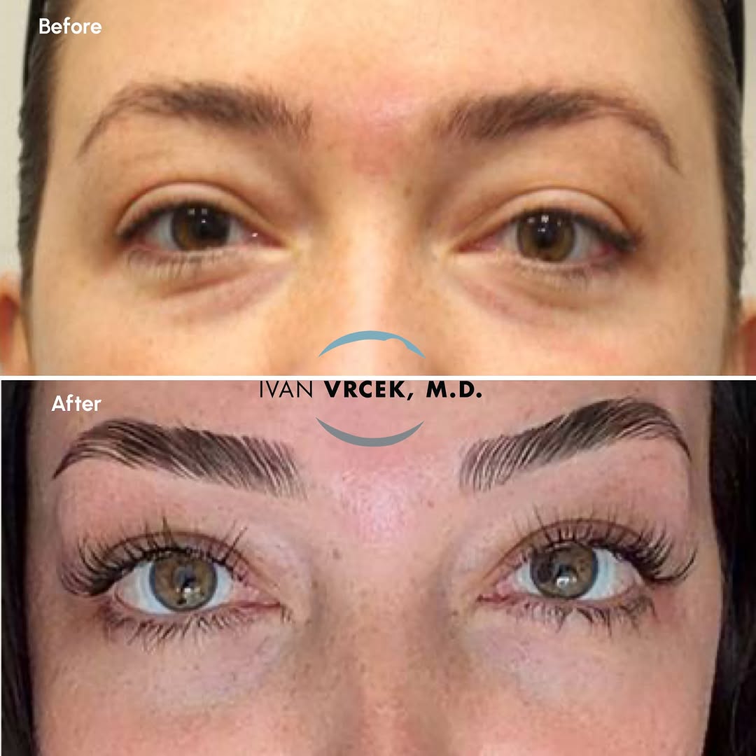 Instagram post by Dr. Ivan Vrcek: Looking gorgeous and refreshed 3 months after lower Blepharoplasty with fat repositioning, filler removal, a skin pinch and a chemical peel …