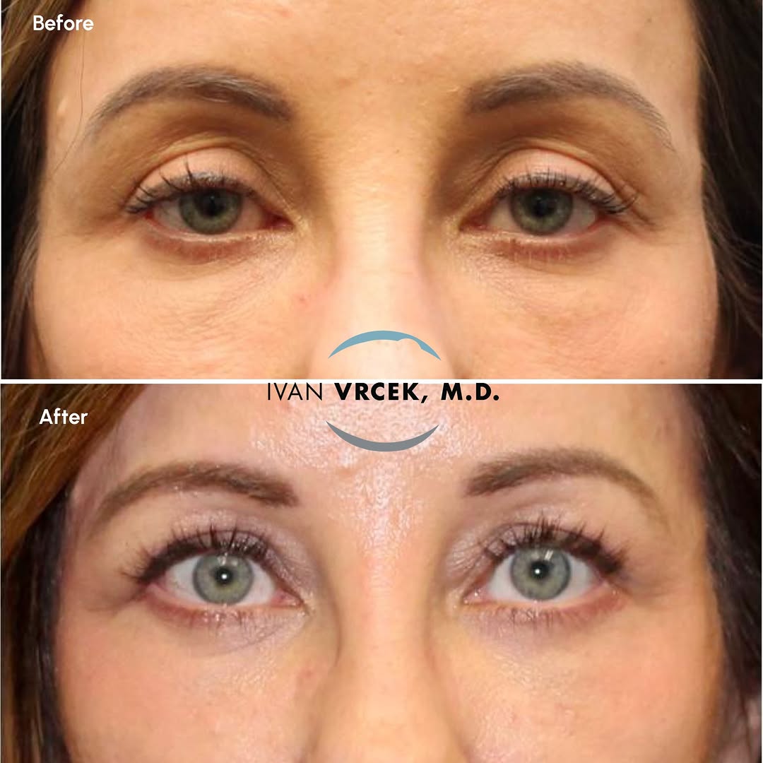 Instagram post by Dr. Ivan Vrcek: When patients come to see me, one of the most common concerns is looking more tired than they feel. This patient really demonstrates the pow…