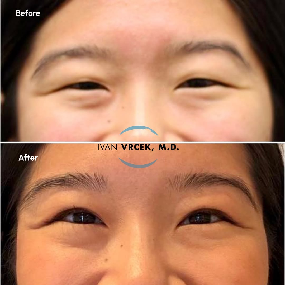 Instagram post by Dr. Ivan Vrcek: This beautiful patient wanted to keep the unique shape of her Asian eyelids, but didn’t want her eyes to disappear when she smiles. She is t…