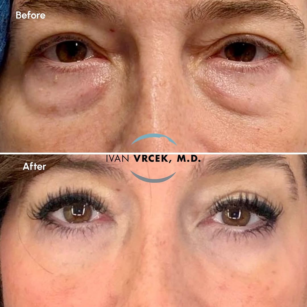 Instagram post by Dr. Ivan Vrcek: Looking and feeling 10 years younger! This lovely patient is thrilled with her results 2 months after a lower Blepharoplasty with fat reposi…