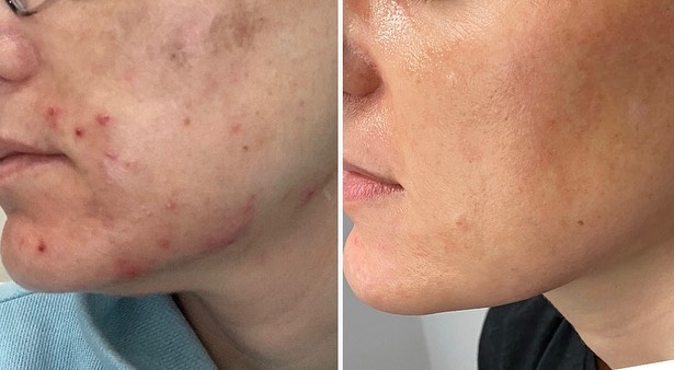 Instagram post by Dr. Ivy DeRosa, DO: As a #boardcertified #dermatologist 👩🏼‍⚕️ Im specialty trained to treat all conditions of skin, hair 💇🏼‍♀️ and nails 💅🏼 My #acne patie…